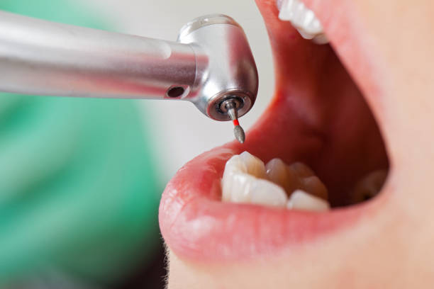 Best Emergency Root Canal Treatment in Derry, PA